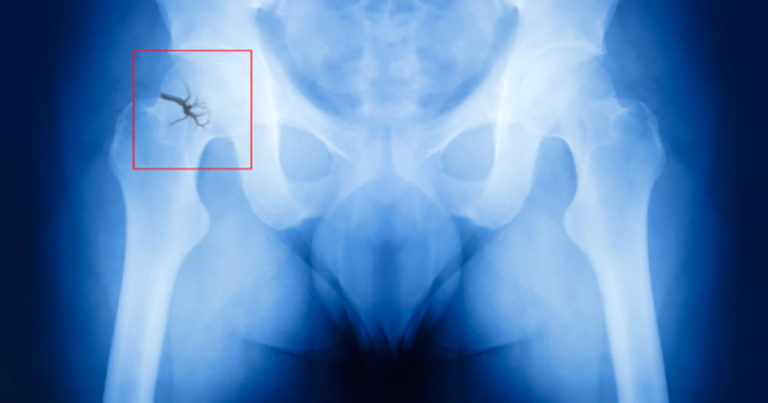 Complicaciones de la osteoporosis